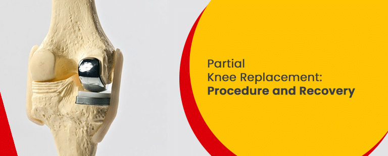 Partial Knee Replacement