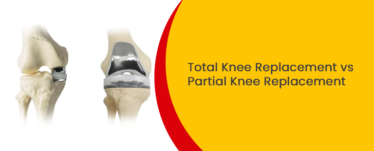 Total Knee Replacement vs Partial Knee Replacement