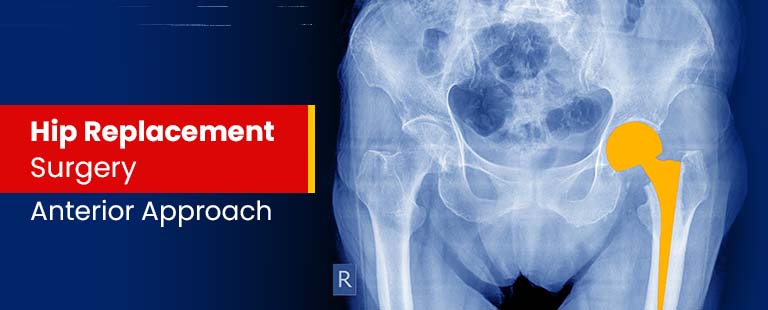 Hip Replacement Surgery Anterior Approach