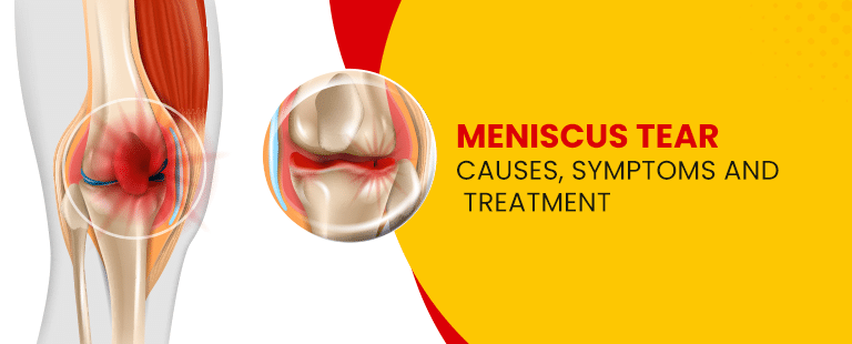 Meniscus tear ,causes ,symptoms